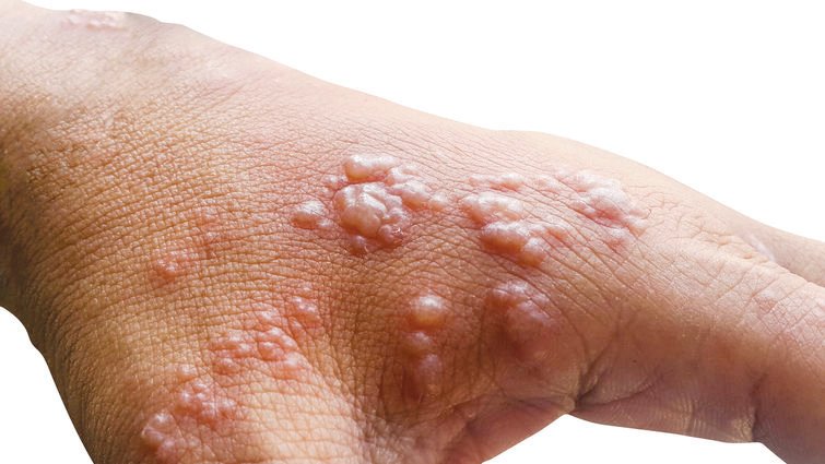 Skin infected Herpes zoster virus on the arms